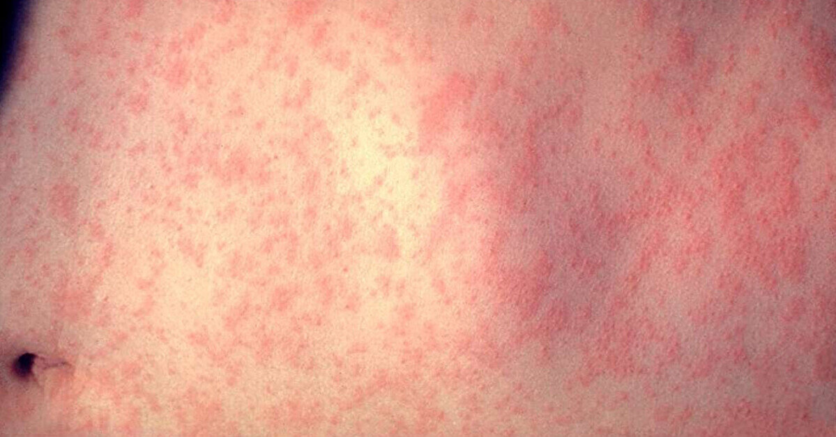 Кількість хворих на кір в Україні збільшилася в 20 разів – повідомляє Міністерство охорони здоров'я.